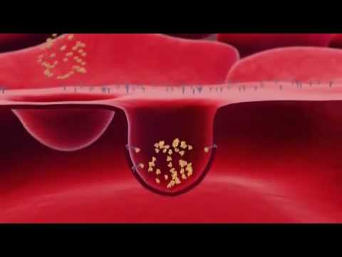 Видео о препарате Абраксан Паклитаксел пор, для инъекций 100мг